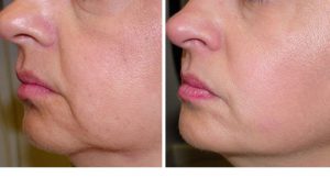 RF-лифтинг лица и тела, фото до и после проведенных процедур